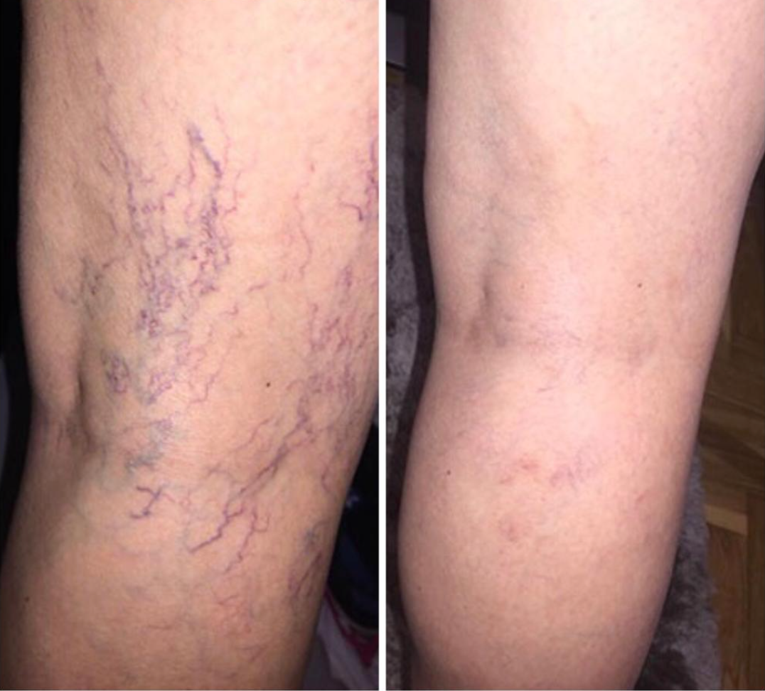 Hadassa®: Mantequilla Restauradora Anti-Estrías