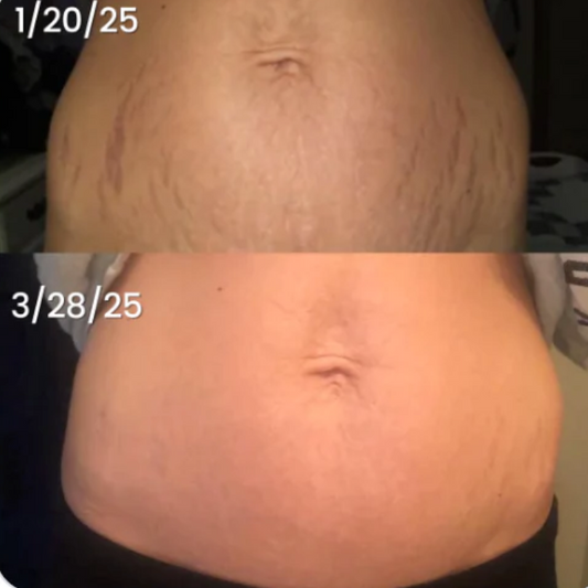 Hadassa®: Mantequilla Restauradora Anti-Estrías