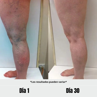 VARICOSE VEINS CREAM® — Diga adiós a las Várices